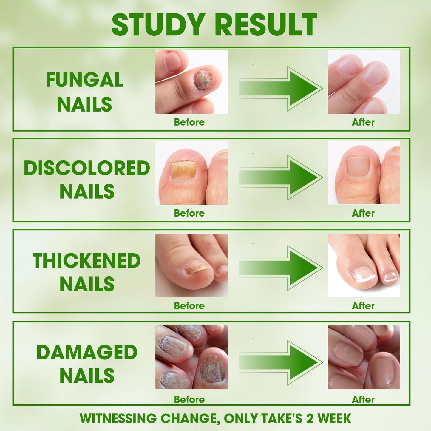 Toenail Fungus Treatment Extra Strength Kit - Complete 4-Step System with Nail Cleansing Solution, Care Oil, Care Cream & Nail Patches, For Ingrown Toenail Treatment & Nail Growth