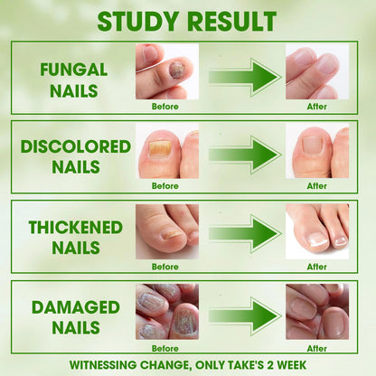 Toenail Fungus Treatment Extra Strength Kit - Complete 4-Step System with Nail Cleansing Solution, Care Oil, Care Cream & Nail Patches, For Ingrown Toenail Treatment & Nail Growth